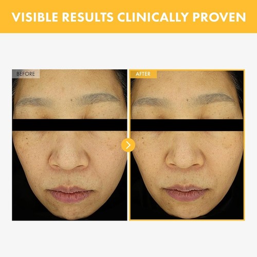 8 Days Spot Cream, Dark Spot Remover for Face, Age Spot, Sun Spot, Freckles, Mel - Picture 4 of 4
