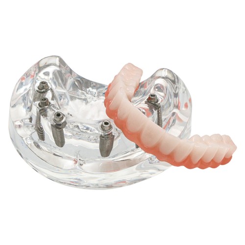 Dental Implant Restoration Model Upper Jaw 6 Screws Post Core Bridges M6001-2 - Picture 9 of 9