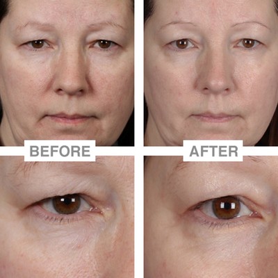 nubrilliance microdermabrasion system