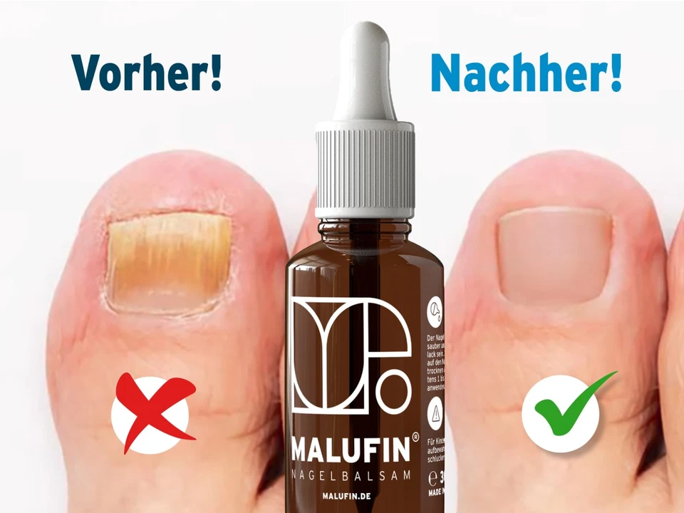 Malufin ® drops for nail fungus - effective treatment for toenails and toenails - Image 2 of 4