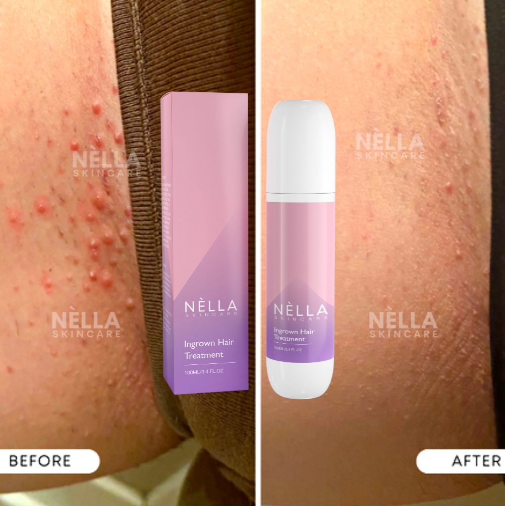 Sérum Anti-Irritación Previene Granos y Espinillas en Área Íntima y Piernas 30mL-image