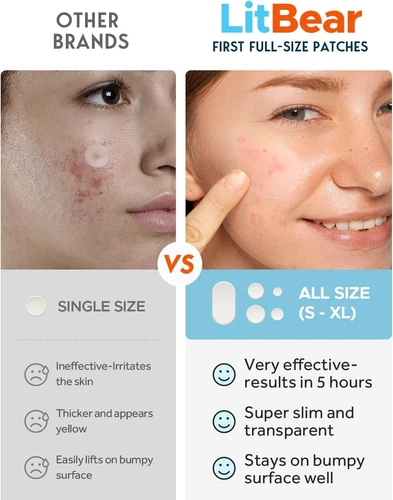 LitBear Acne Pimple Spot Patches for Large Zit Breakouts, Acne Patches for Face,