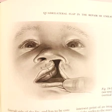 Vintage Cleft Lip and Palate Surgical Dental and Speech Book Hardcover 1971