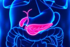 Inoperable pancreatic tumour regressed unexpectedly on antifungal medication