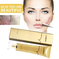 Scar Removal Cream for Acne, Surgery, Burns, Keloids, Stretch Marks