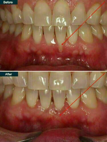 Extra Strength Super Potent Gum Disease Cure Stop Bleeding Receeding Gums Teeth