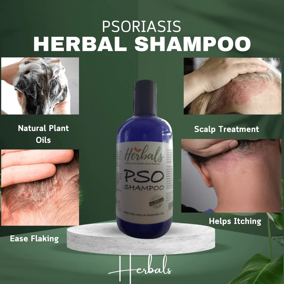 Natural Psoriasis Shampoo – Handmade Relief for Dry, Flaky, Itchy Scalp – 250ml - Image 2 of 4