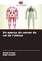 Un AperçU Du Cancer Du Col De L'utéRus Ashok Kumar