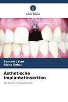 Sumeet Jalan (U. A.) | ÄSthetische Implantatinsertion | Taschenbuch | Deutsch