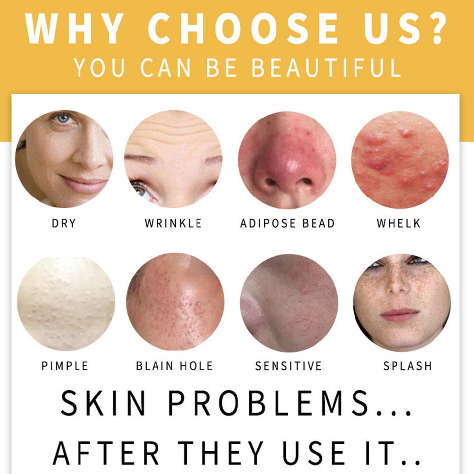 Tumeric Soap Acne Dark Spots Removal Skin Whitening Body Bleaching Soap