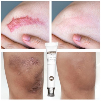 repair remove scar cream