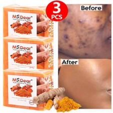 3X Tumeric Soap For Dark Spots, Skin Lightening, Anti Acne Skin Cleansing Soap