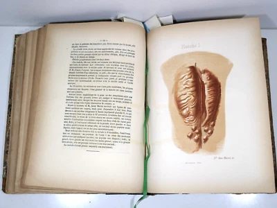 Médecine (1879) OBSTETRIQUE - PATHOLOGIE DE L’UTERUS (EO) Recueil de 10 thèses - Photo 1/4