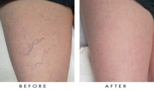 Lux Vitamin K Cream - Eliminate Spider Varicose Veins Scars Rosacea Capillaries - Picture 2 of 8