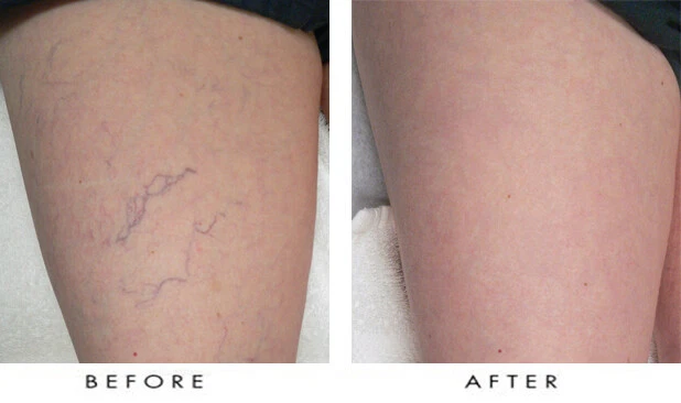 Lux Vitamin K Cream - Eliminate Spider Varicose Veins Scars Rosacea Capillaries - Image 2 of 4