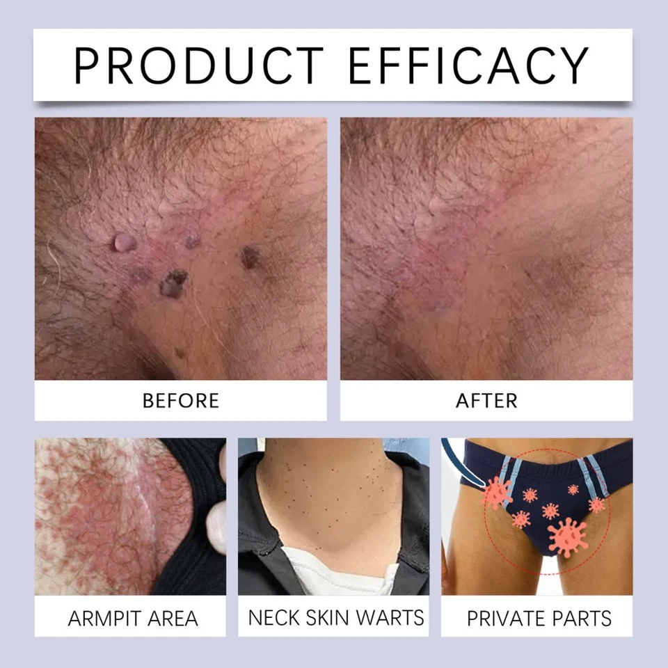 Wart Remover Fast Acting Gel Wart Remover Freeze Off - Fast-Acting Wart Ointment - image 3 of 4