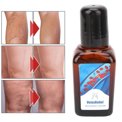 2pcs Veins Relief Treatment Seren Beruhigend Reduzieren Schmerzen Spider Vei TOS