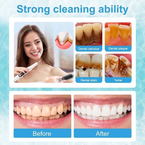 Electric Ultrasonic Tooth Cleaner Oral Teeth Stain Dental Cleaning Remover Kit - Picture 5 of 17