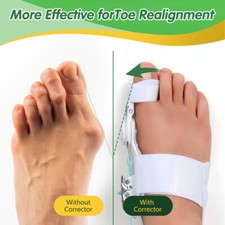 Hallux Valgus Bunion Big Toe Corrector Splint Foot Straightener Pain Relief