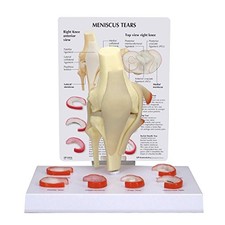 Meniskus-Kniemodell GPI Anatomicals 1010 mit 6 Rissen, Anatomie Modell