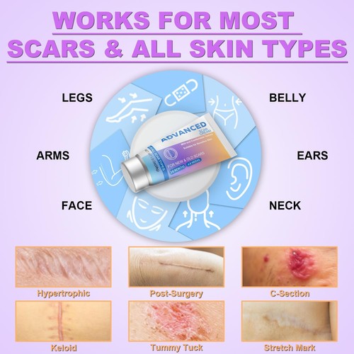 Silicone Scar Cream Scar Gel - Advanced Scar Treatment Keloid Bump Removal fo... - Picture 5 of 6