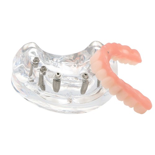 Implante dental todo en 4/6 sobredentadura modelo mandíbula superior restauración 4/6 tornillos - Imagen 15 de 26
