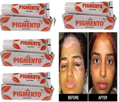 PIGMENTO OINTMENT FOR REPIGMENTATION IN VITILIGO ANTIFUNGAL PROPERTIES 50G X4