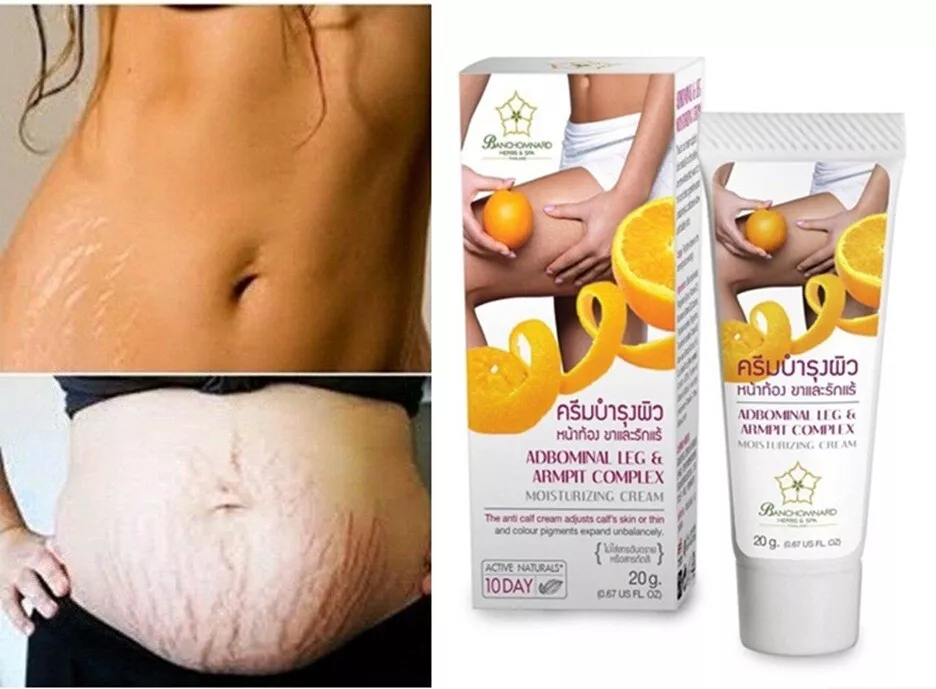 Best stretch mark removal online