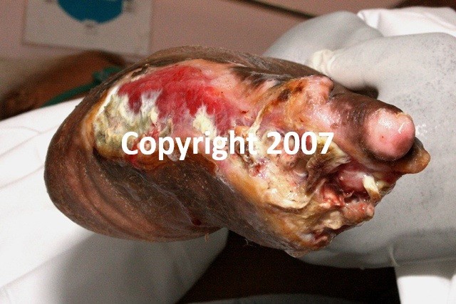 Original Gruesome Photograph - Gangrene Foot Medical-Legal Evidence Photo Signed