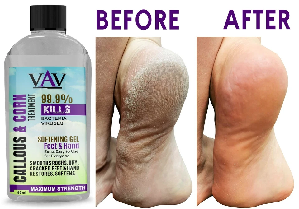 VAV Best Callus Remover, Callus Eliminator, Liquid & Gel For Corn And Callus 50ML