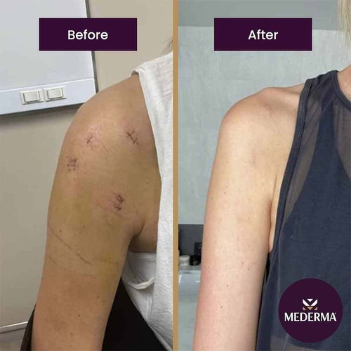 Mederma Advanced Scar Gel Cream Treatment Skin Care Old & New Scars - 50g Hot - Picture 8 of 10