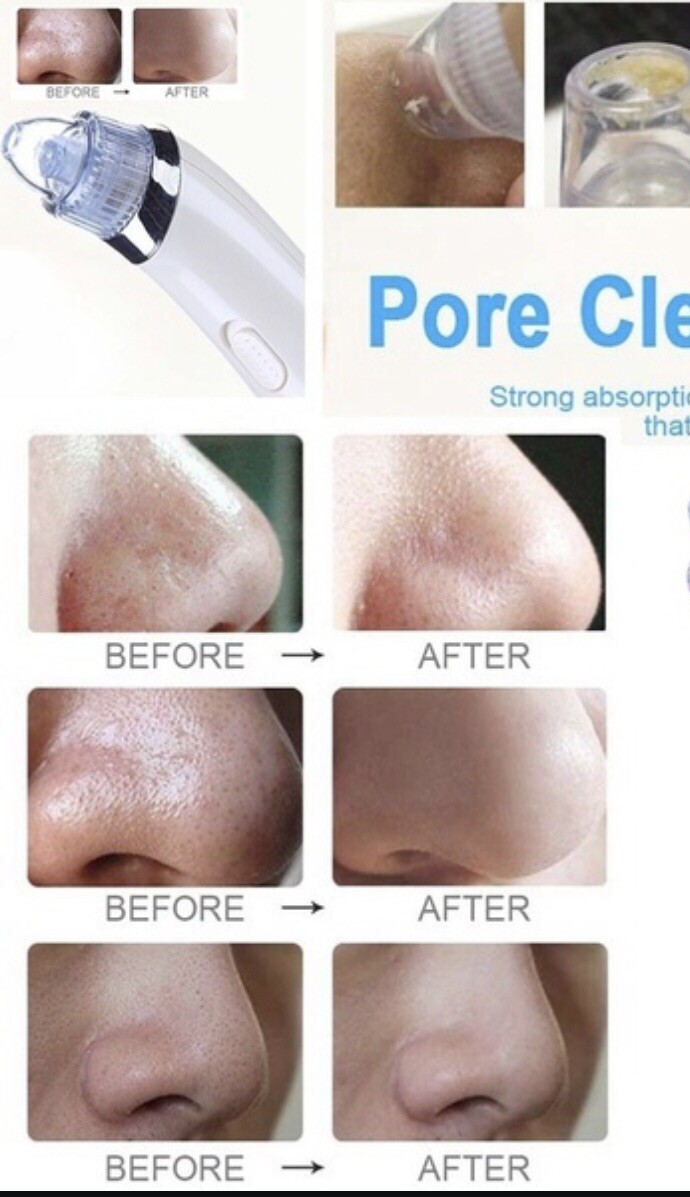 facial skin care acne blackhead remover vacuum suction pore clean machine