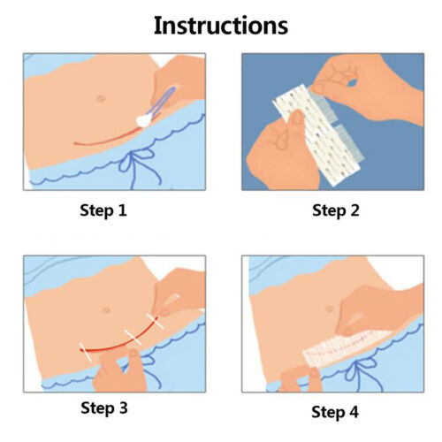 Sterile First Aid Wound Skin Closures Surgical Adhesive Steri Strip Skin Rep-lk - Bild 7 von 17