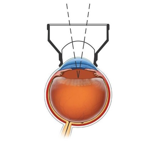Obiettivo laser iridectomia YAG con presa salda bordo in metallo oftalmologia e optometria - Foto 9 di 9