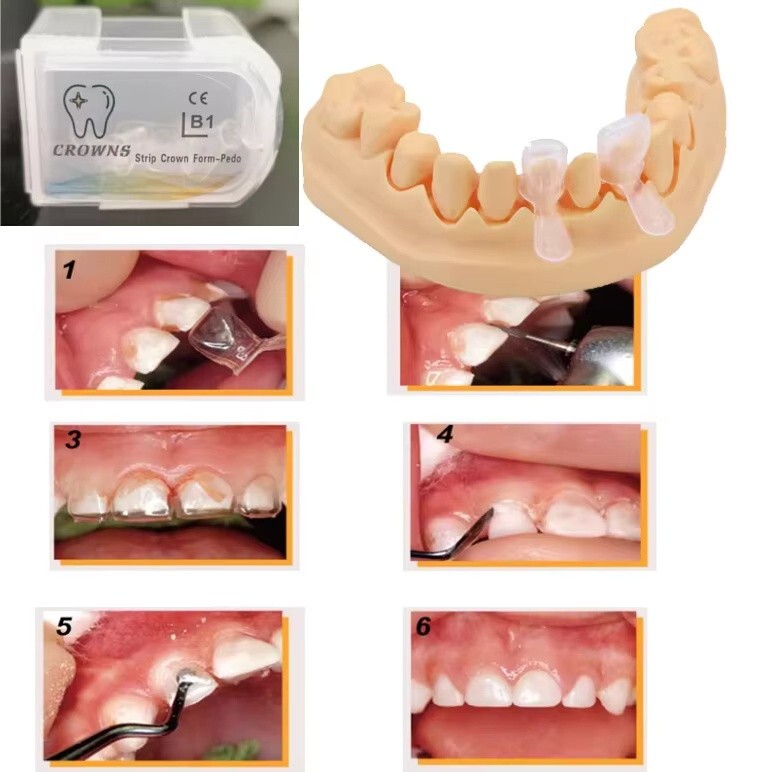 5*Dental Kids Strip Crowns Form-Pedo Pediatric Deciduous Primary
