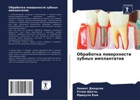 Obrabotka Powerhnosti Zubnyh Implantatow Hemant Dzhadhaw