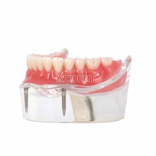 Dental Implant Teeth Model Mandibular Overdenture Restoration 2 Lower Implants - Picture 4 of 9