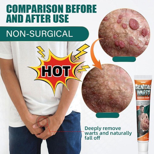 Sumifun Genital Wart+Removal Cream Relieve Discomfort Fast- - Picture 2 of 9