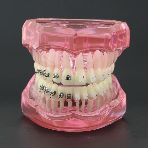 Dental Orthodontic Teeth Study Model with Metal Ceramic Bracket Braces 3003 - Picture 3 of 33