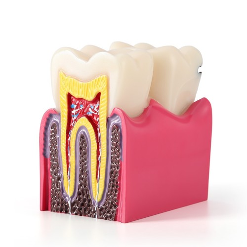6 Times Dental Caries Tooth Model Decay Teeth Comparative Study Model Teaching - Picture 16 of 19