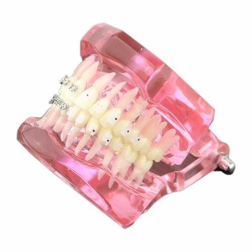 Dental Orthodontic Teeth Study Model with Metal Ceramic Bracket Braces 3003 - Picture 11 of 33