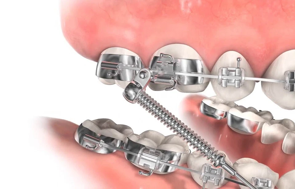 Orthodontic Class II Corrector Fatigue Resistant Device Push Rod 22-38mm Forsus - Image 4 of 4