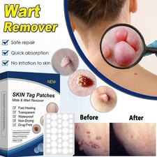 Skin Tag Remover Patches Quick Effective Mole and Wart Pad Removal Sticker US