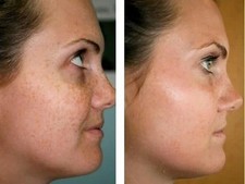 KOJIC ACID Skin Whitening - Lightening - Brightening Serum Dark Spots Solution