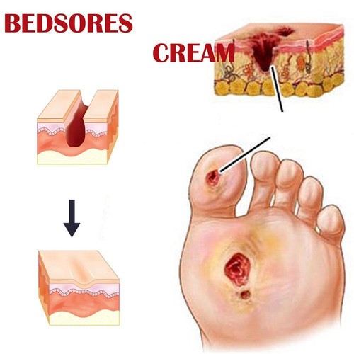 Bed Sore Cream Bedsore Ointment Bed Sores Treatment Fast Wound Healing Gel,20g - Picture 9 of 13