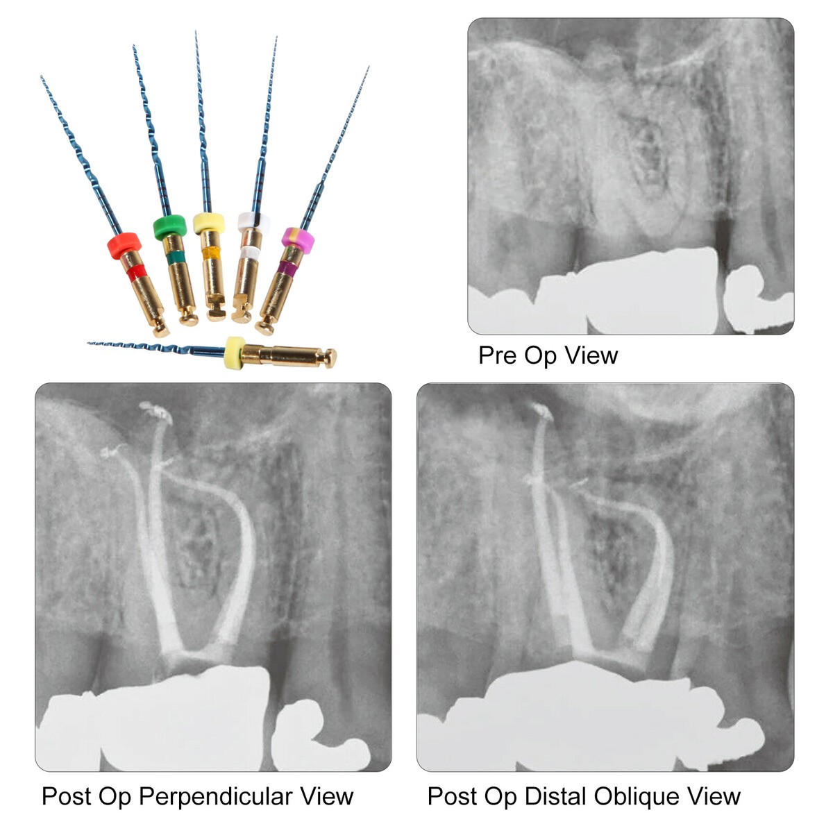 Lima Endodontica Sandent Super Niti &ndash; Per Canali Radicolari, Uso Motore, CE FDA
