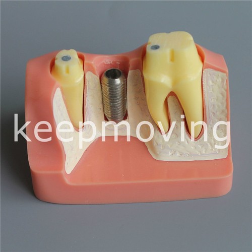 Dental Implant Analysis Crown Bridge Demonstration Teeth Tooth Model Typodont - Picture 6 of 7