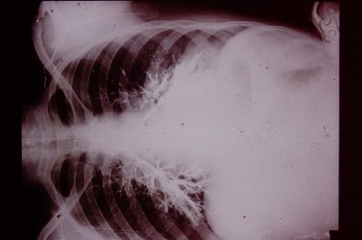 No Date Medical Slide X-Ray Mass Produced  Slide CD-L