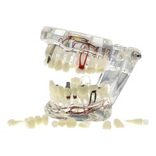 Dental Oral Typodont Model Implant Pathological Removable Teach Visible Anatomy