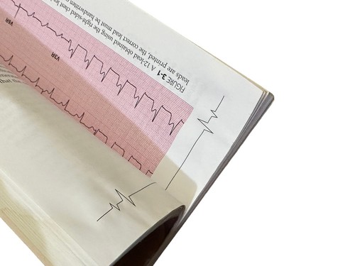 Pocket Reference to the 12-Lead ECG in Acute Coronary Syndromes Revised 2nd Ed. - Picture 4 of 6